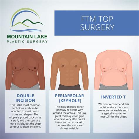 How Much Is Top Surgery Uk Uncover The Ultimate Price Guide Amp Tips For A Fabulous